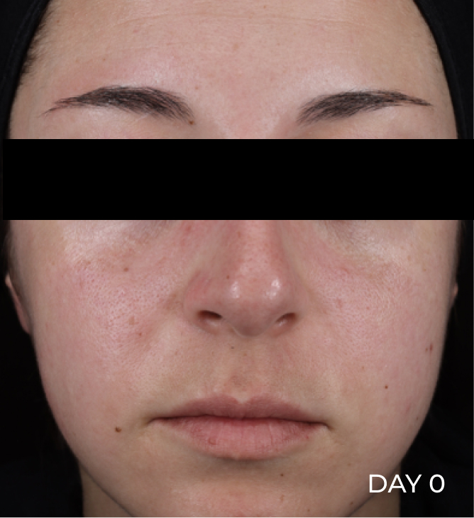 Face before using Pro-Repair Serum with visible areas of redness