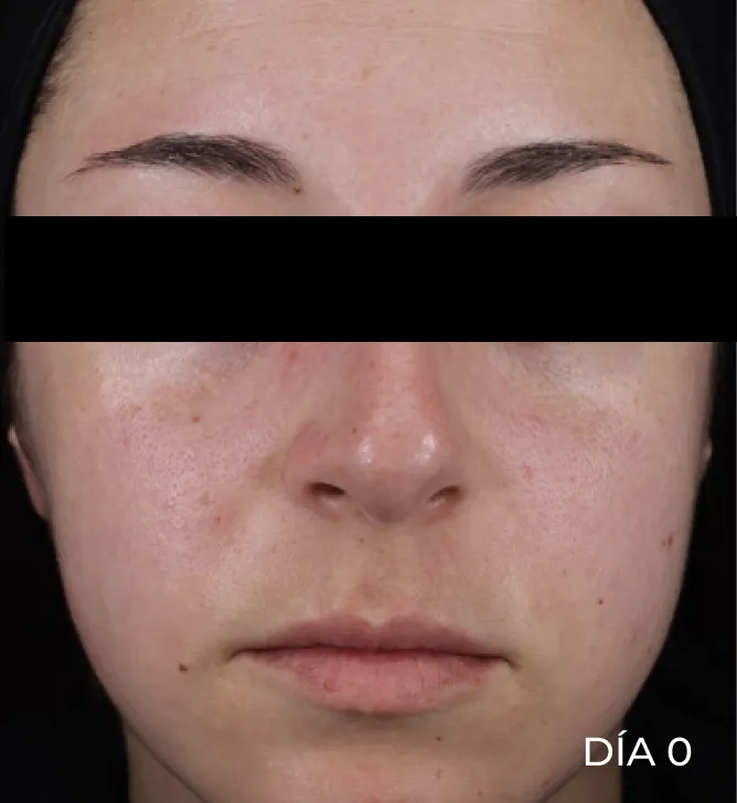 Rostro antes de usar Pro-Repair Serum con rojeces visibles