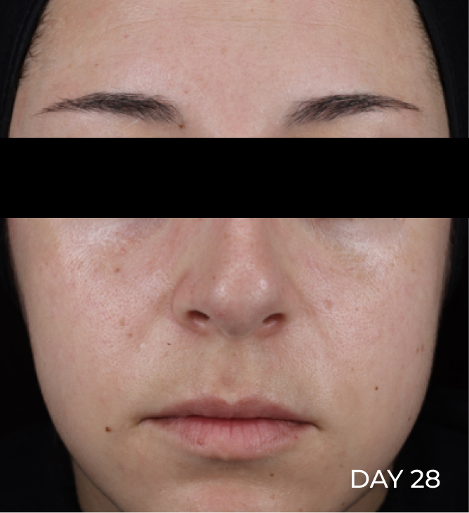 Face after using Pro-Repair Serum and letting sit for 15 minutes with redness visibly reduced in the cheek area
