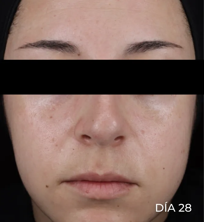 Rostro después de usar Pro-Repair Serum y dejar actuar por 15 minutos con rojeces visiblemente reducidas en zona de mejillas y entrecejo