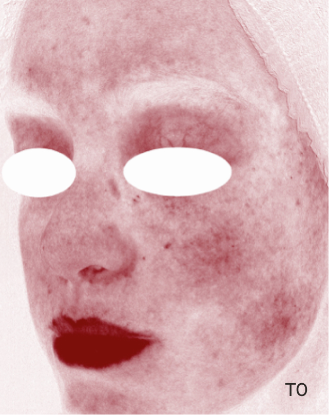 Rostro antes de usar Pro-Repair Serum con rojeces visibles