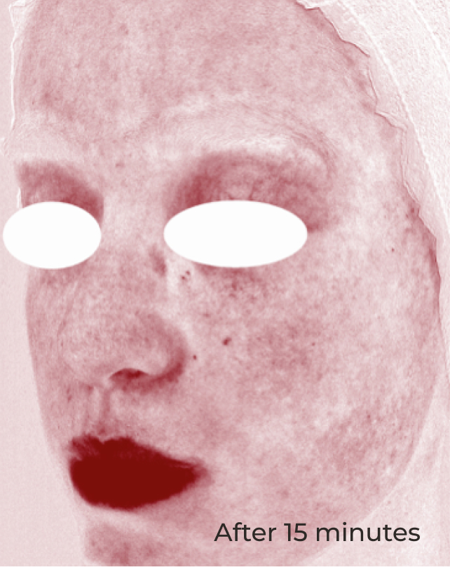 Rostro después de usar Pro-Repair Serum y dejar actuar por 15 minutos con rojeces visiblemente reducidas en zona de mejillas y entrecejo
