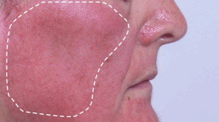foto que muestra el antes y después de una mujer que se realizó un tratamiento de microneedling y utilizó NB Ceutical Pro-Repair para tratar su piel