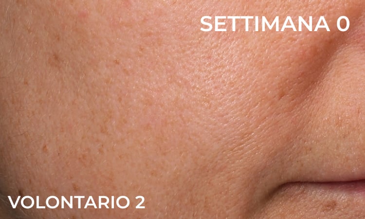 Prima – riduzione del solco naso-labiale