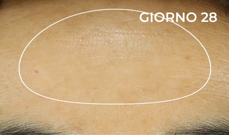 Riduzione nella zona della fronte dopo
