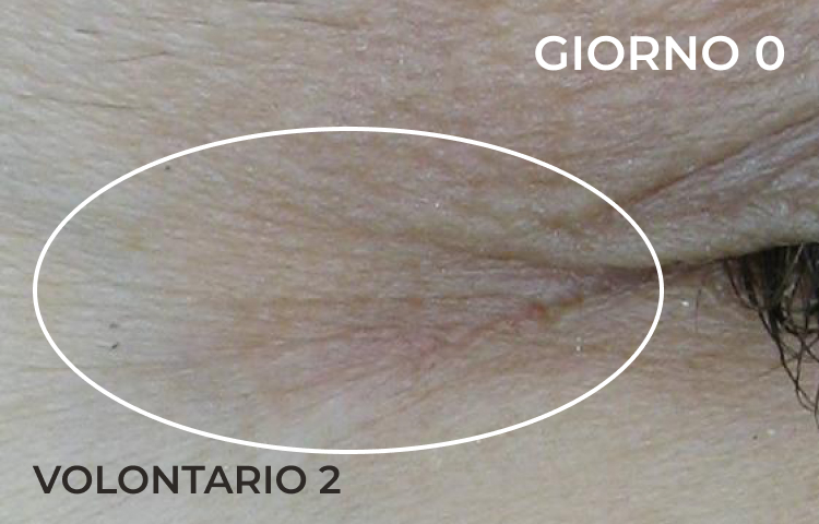 Riduzione della piega nasolabiale dopo