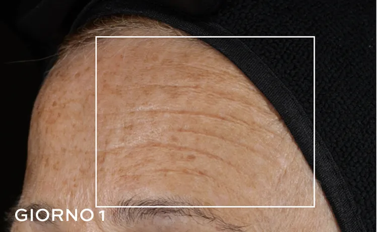 Foto de antes de una frente con visibles arrugas