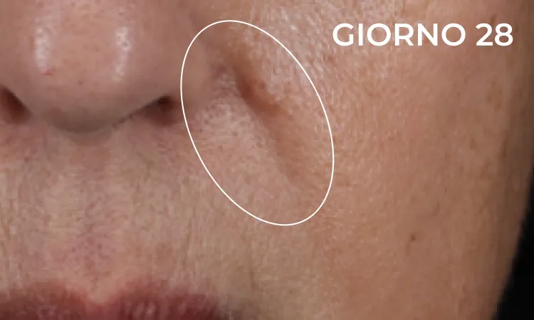 Reducción de arruga nasolabial