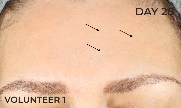 Reduction in forhead wrinkles before
