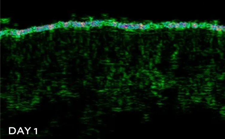 Before picture of oily and acne prone skin with blemishes