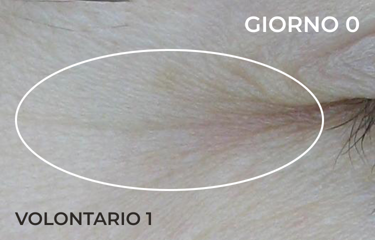 Riduzione della piega nasolabiale dopo