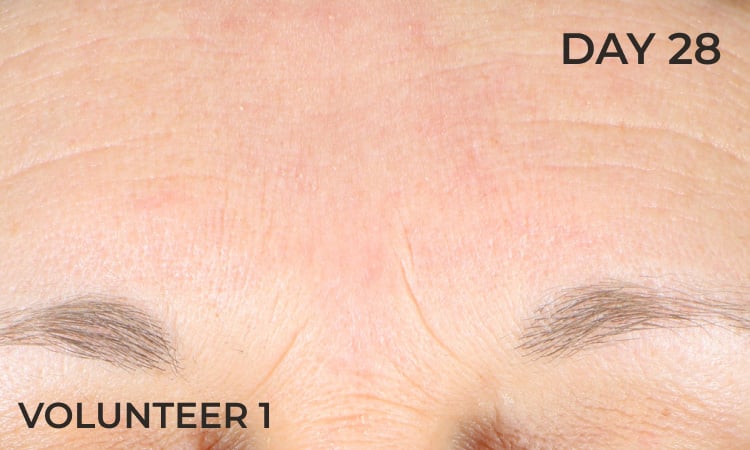 Reduction in forehead wrinkles before