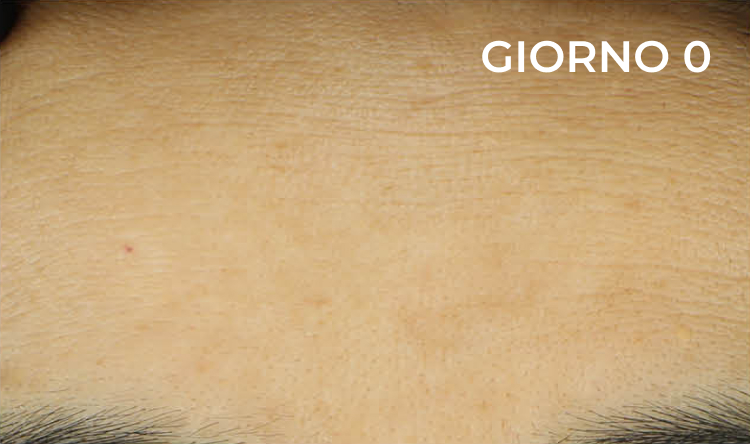 Riduzione nella zona della fronte prima