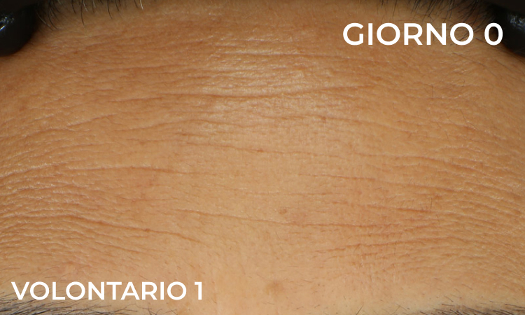 Immagine prima dell’utilizzo del prodotto: rughe visibili sulla fronte