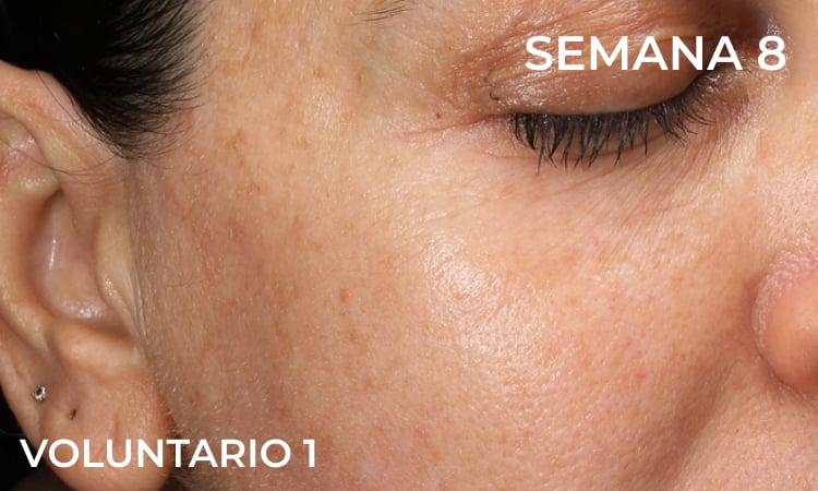 Reduction in forehead wrinkles before