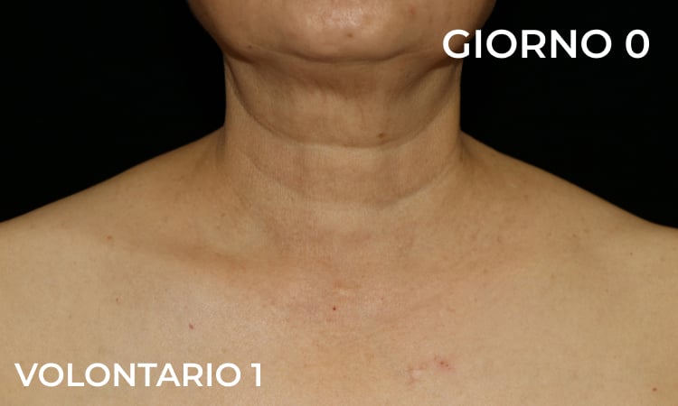 Riduzione delle rughe del collo prima