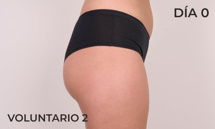 Lifting de glúteos antes