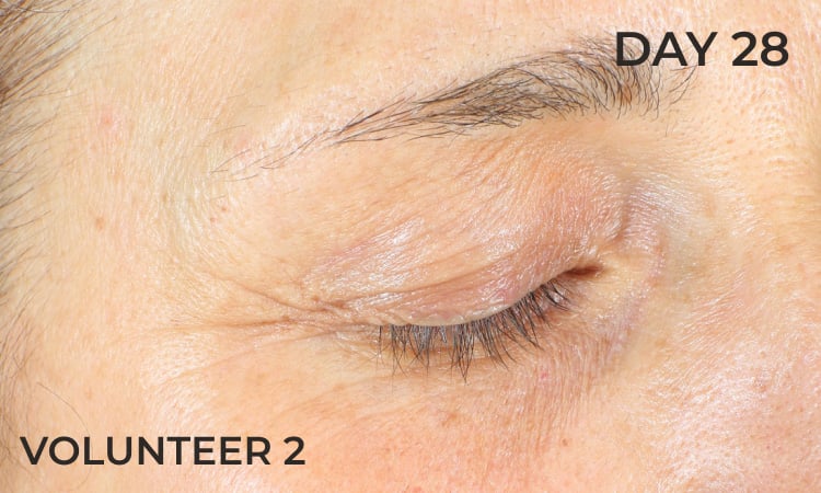 Reduction in eye lines after