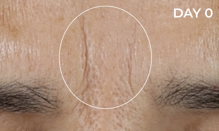 Reduction in neck lines before