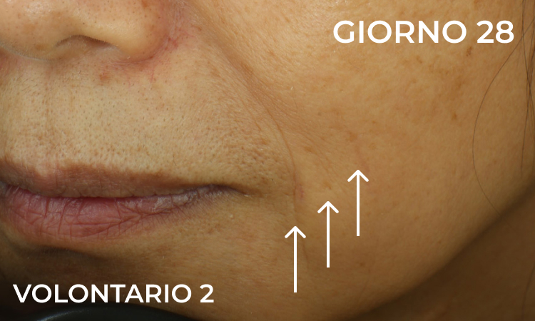 Immagine dopo 28 giorni di trattamento: linee di espressione attenuate e pelle più uniforme