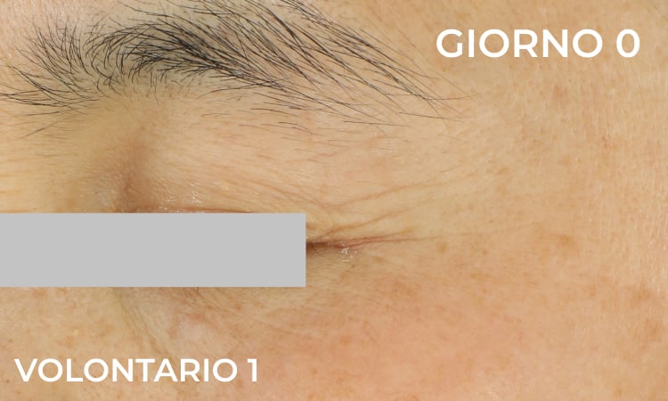 Riduzione delle linee di espressione (prima)