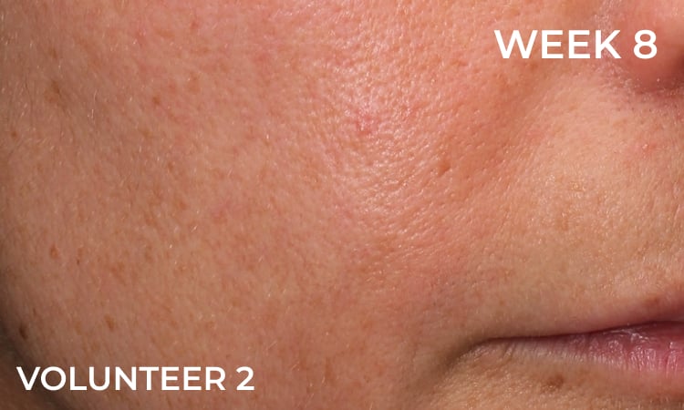 Reduction in forehead wrinkles before