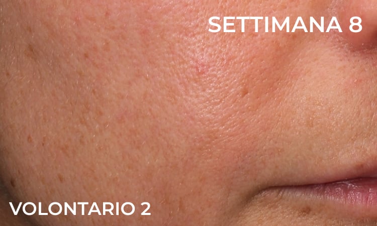 Dopo – riduzione del solco naso-labiale