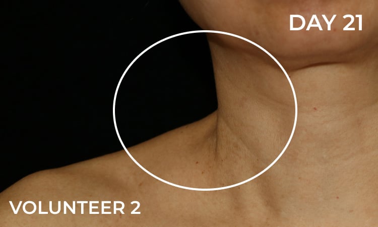 Reduction in neck lines after