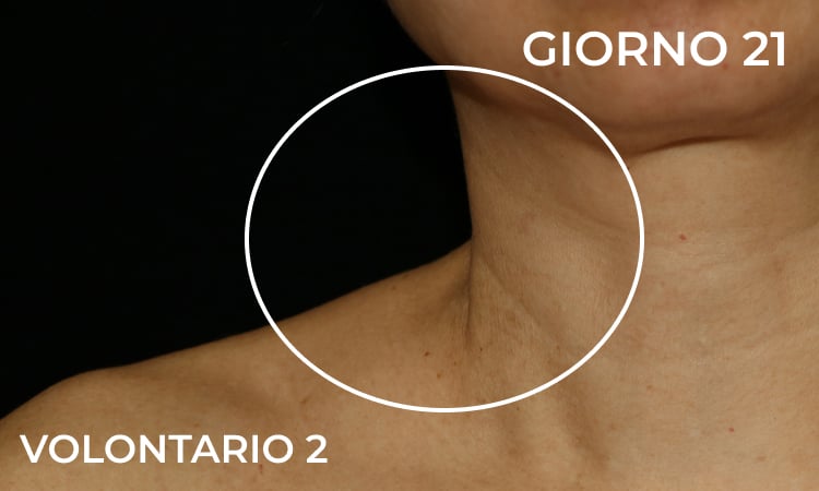 Riduzione delle rughe del collo dopo