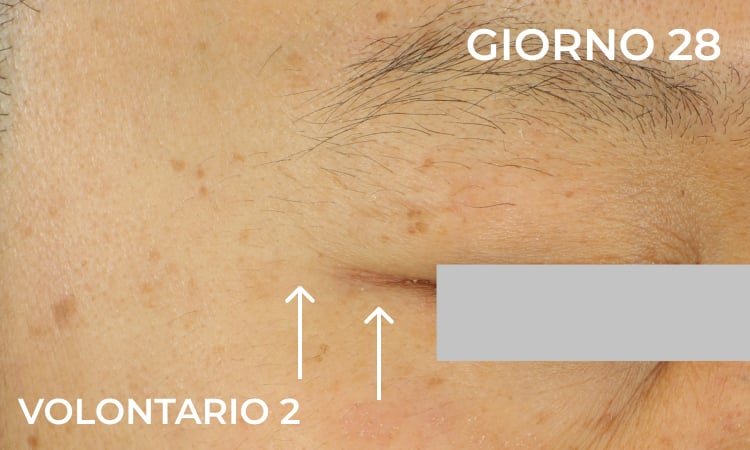 Riduzione delle zampe di gallina (dopo)