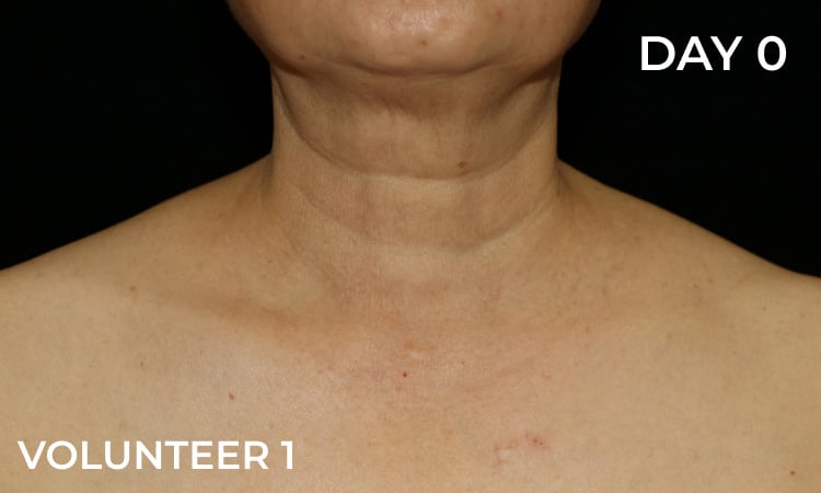 Reduction in neck wrinkles before