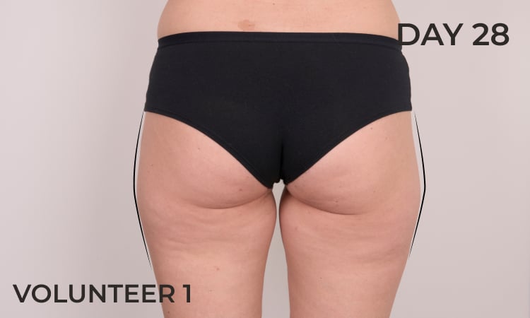 Reduction in thigh contour after