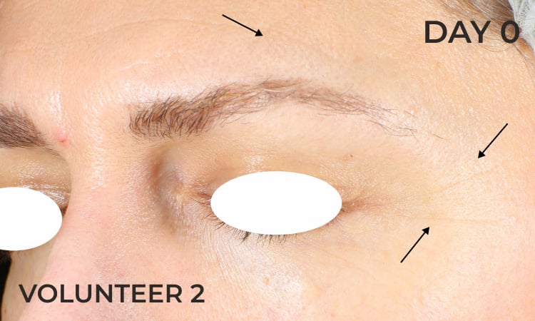Reduction in eye lines before