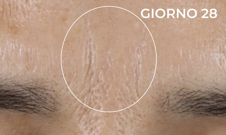 Reduction in neck lines after