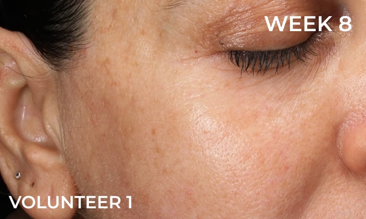Reduction in forehead wrinkles before