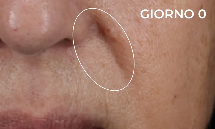 Reduction in neck wrinkles before