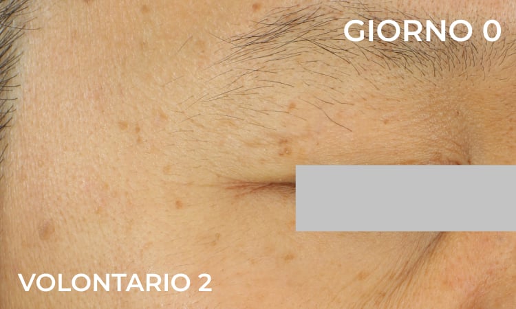 Riduzione delle zampe di gallina (prima)