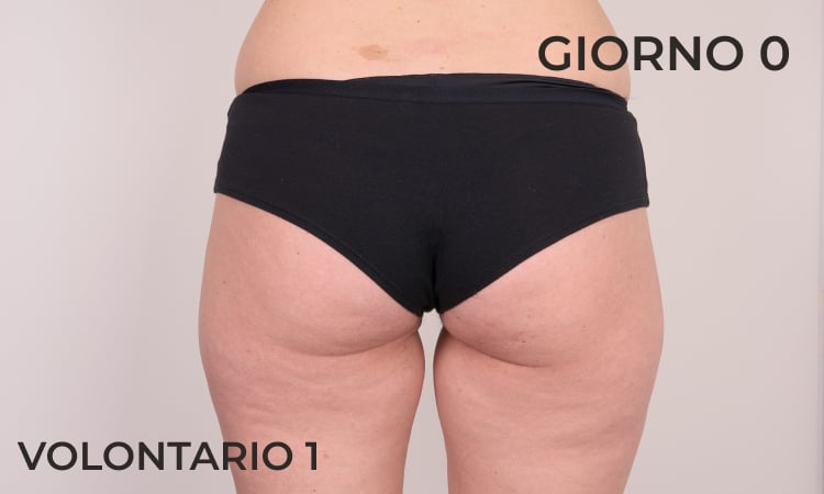 Riduzione della circonferenza delle gambe prima
