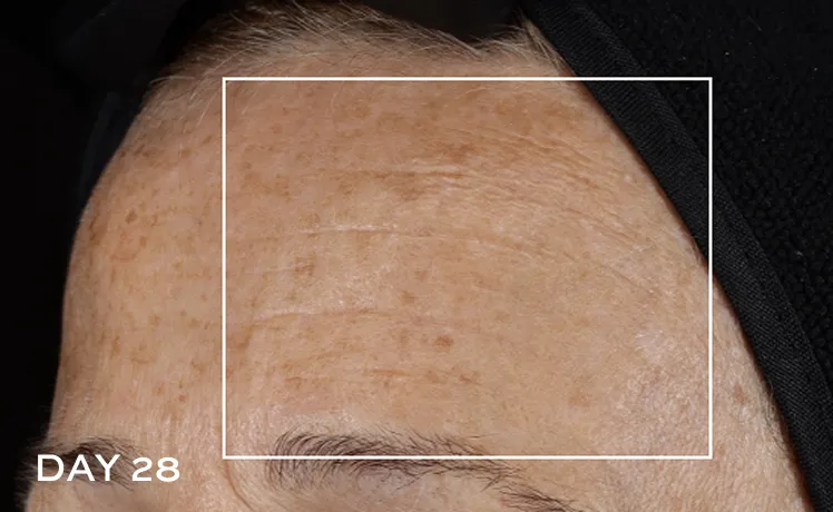After picture of forehead with less visible wrinkles