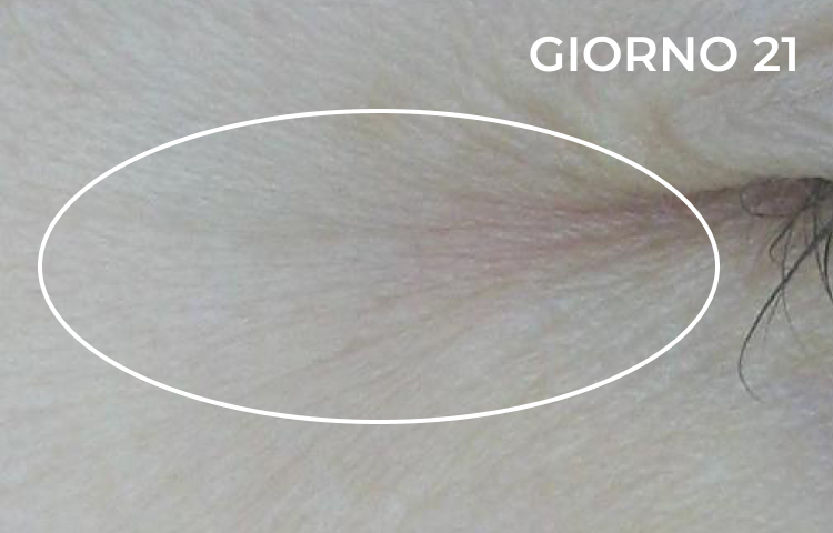 Riduzione della piega nasolabiale dopo