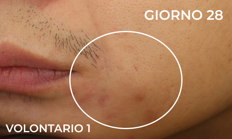 Volontario 1 - dopo 28 giorni di trattamento (riduzione visibile delle imperfezioni)