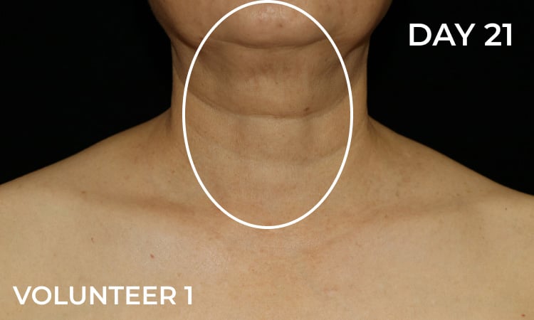 Reduction in neck wrinkles before