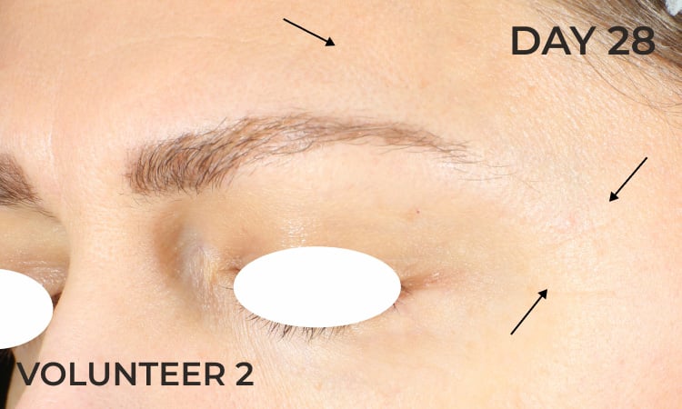 Reduction in eye lines after