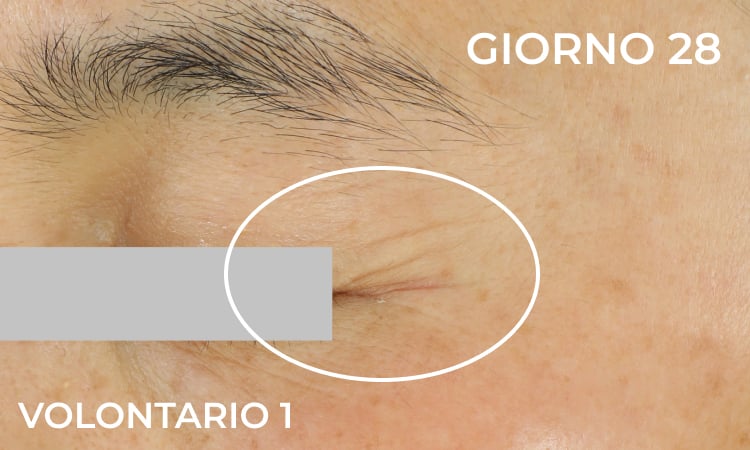 Riduzione delle linee di espressione (dopo)