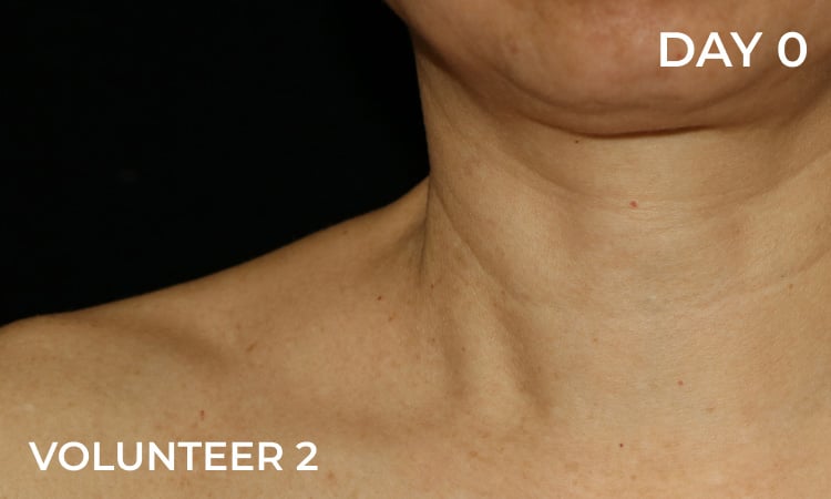 Reduction in neck lines before