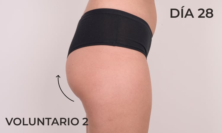 Lifting de glúteos antes