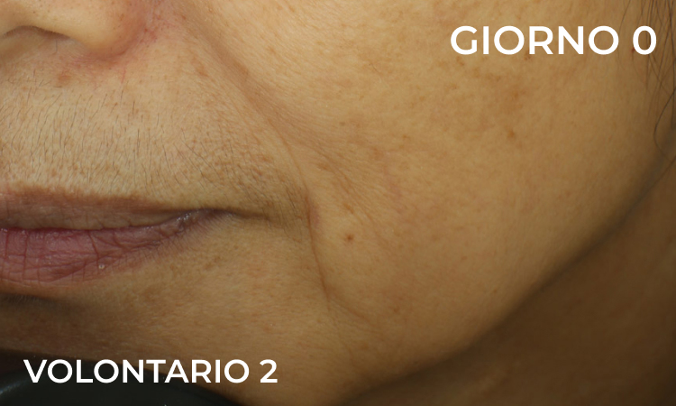 Immagine prima del trattamento: linee di espressione visibili