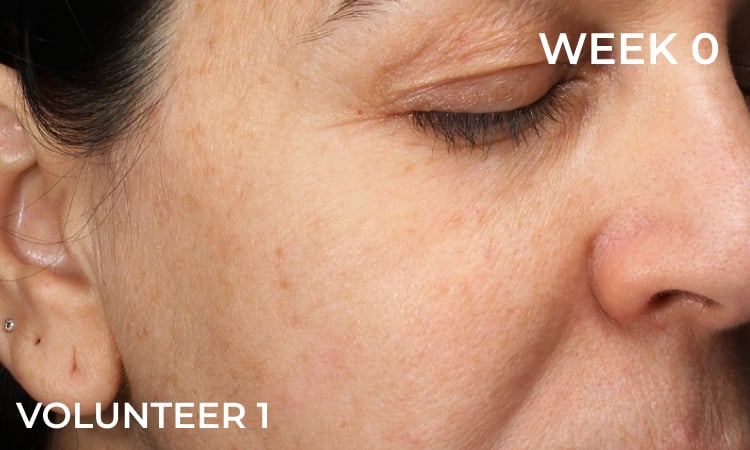 Reduction in forehead wrinkles before