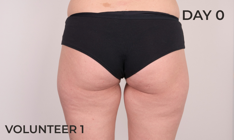 Reduction in thigh contour before