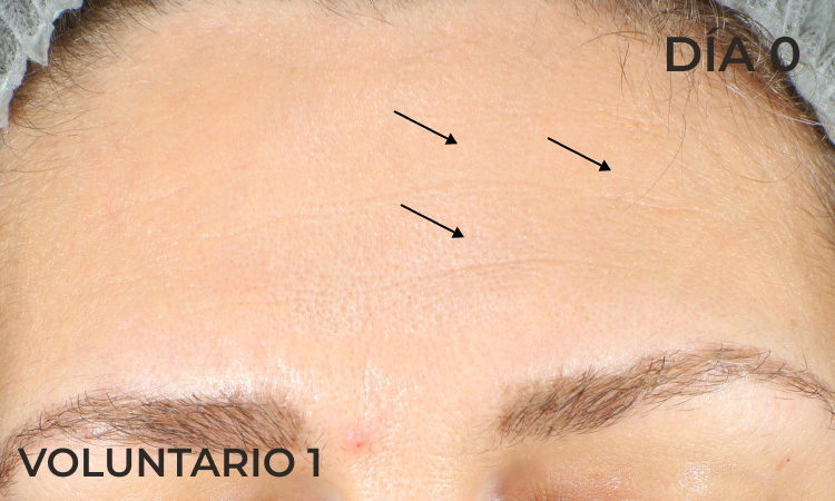 Foto demostrando la reducción de arrugas de la frente antes de la aplicación de producto